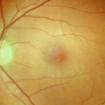 covid-19-linked-to-alzheimer-s-like-plaques-in-eyes-and-brain
