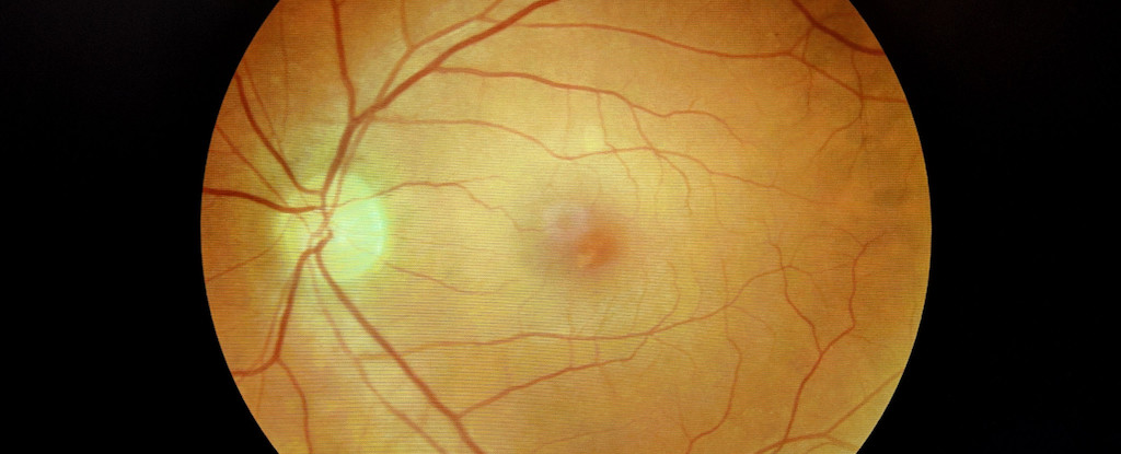 covid-19-linked-to-alzheimer-s-like-plaques-in-eyes-and-brain