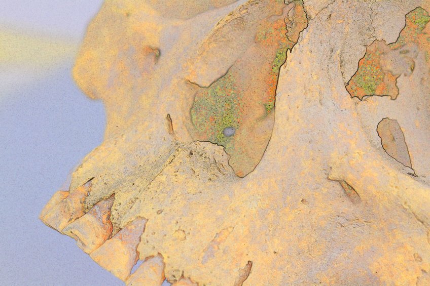 discovery-of-ancient-leprosy-strain-in-americas-challenges-historical-understanding