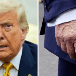 donald-trump-diagnosed-with-chronic-venous-insufficiency