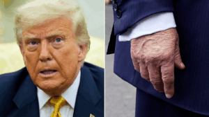 donald-trump-diagnosed-with-chronic-venous-insufficiency