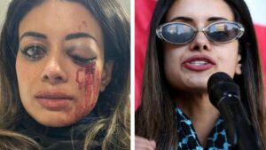 former-greens-candidate-criticizes-police-following-protest-injury