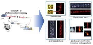 researchers-unveil-noninvasive-stent-imaging-using-light-and-sound