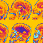 study-links-shingles-and-rsv-vaccines-to-lower-dementia-risk