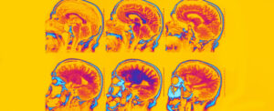 study-links-shingles-and-rsv-vaccines-to-lower-dementia-risk