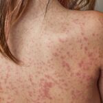 sydney-on-alert-measles-warning-after-traveler-returns-from-vietnam