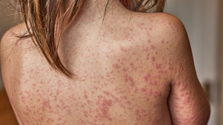 sydney-on-alert-measles-warning-after-traveler-returns-from-vietnam