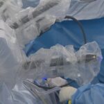 breakthrough-robot-surgery-offers-hope-for-endometriosis-patients