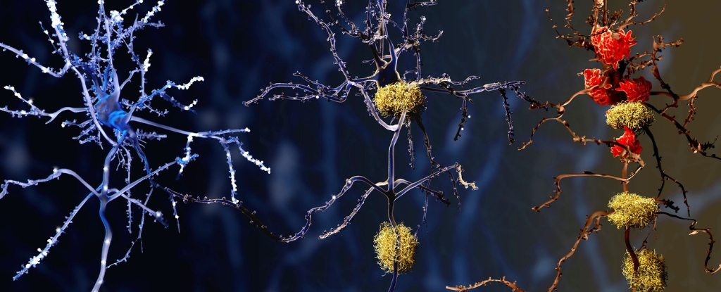 new-research-uncovers-immune-cell-changes-behind-alzheimer-s