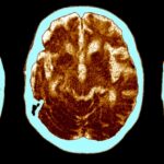 routine-shingles-vaccine-linked-to-20-lower-dementia-risk