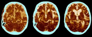 routine-shingles-vaccine-linked-to-20-lower-dementia-risk