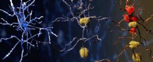 scientists-uncover-immune-cell-changes-linked-to-alzheimer-s-disease