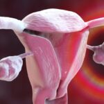 hysterectomy-linked-to-increased-stroke-risk-new-research-reveals