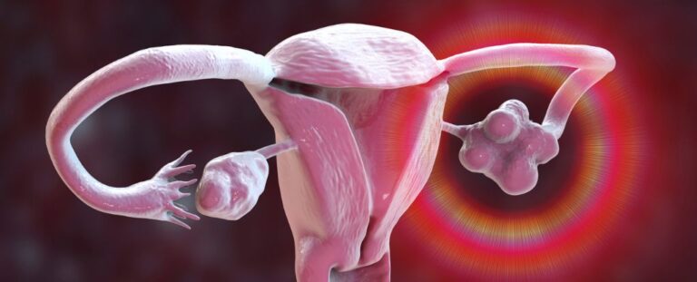 hysterectomy-linked-to-increased-stroke-risk-new-research-reveals
