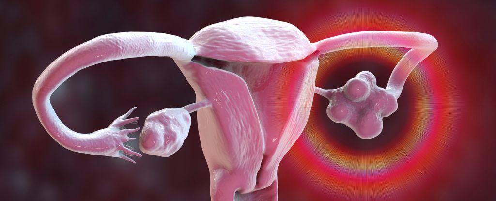hysterectomy-linked-to-increased-stroke-risk-new-research-reveals