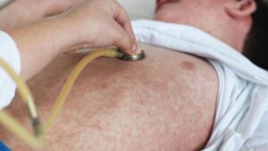 perth-confirms-two-measles-cases-linked-to-bali-travel
