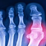 scientists-revive-ancient-gene-to-combat-gout-and-related-diseases