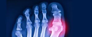 scientists-revive-ancient-gene-to-combat-gout-and-related-diseases