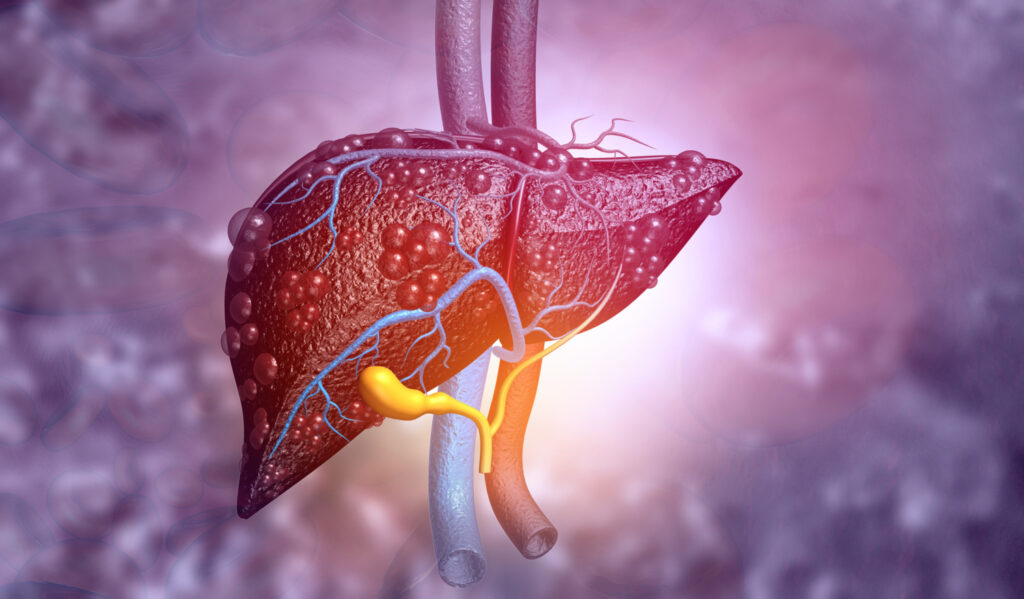 Diseased liver