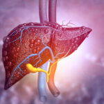 Diseased liver