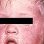 urgent-alert-measles-case-confirmed-in-queensland-mining-town