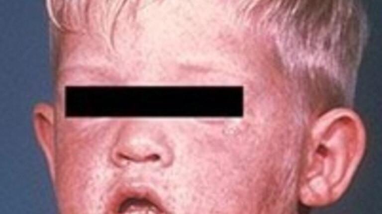 urgent-alert-measles-case-confirmed-in-queensland-mining-town