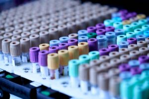new-blood-test-revolutionizes-alzheimer-s-diagnosis-and-access
