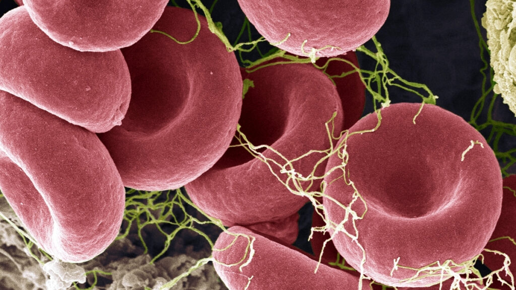 new-blood-test-shows-promise-in-detecting-me-cfs