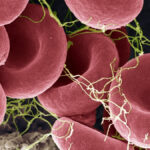 new-blood-test-shows-promise-in-detecting-me-cfs