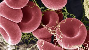 new-blood-test-shows-promise-in-detecting-me-cfs