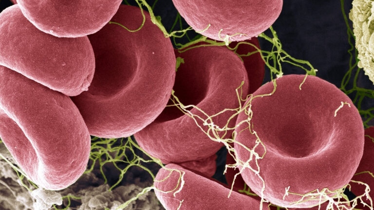 new-blood-test-shows-promise-in-detecting-me-cfs