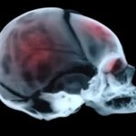 new-podcast-episode-explores-impact-of-shaken-baby-syndrome