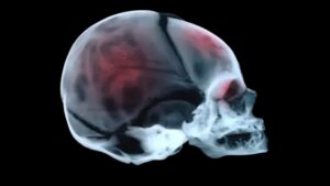 new-podcast-episode-explores-impact-of-shaken-baby-syndrome