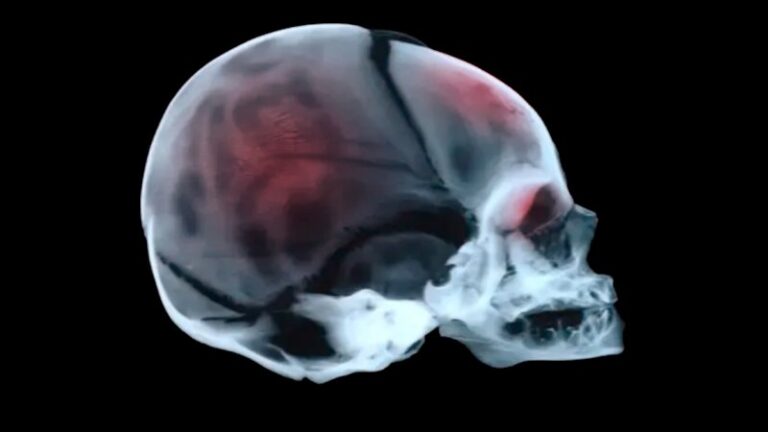 new-podcast-episode-explores-impact-of-shaken-baby-syndrome