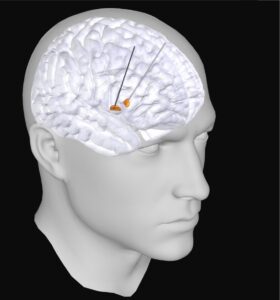researchers-uncover-new-electrical-signature-for-parkinson-s-disease