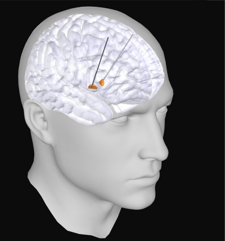 researchers-uncover-new-electrical-signature-for-parkinson-s-disease