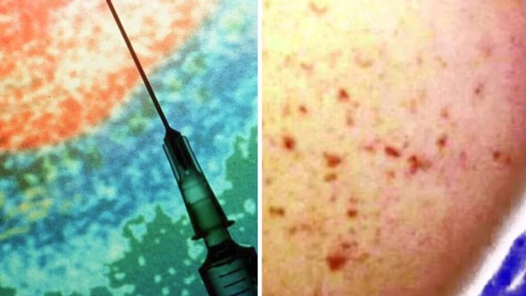 urgent-health-alert-issued-after-meningococcal-cases-in-australia