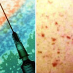 urgent-health-alert-issued-after-meningococcal-cases-in-australia