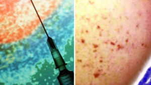 urgent-health-alert-issued-after-meningococcal-cases-in-australia
