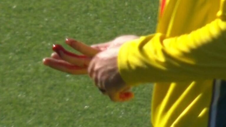 urgent-update-matt-short-injured-after-catch-attempt-bleeds