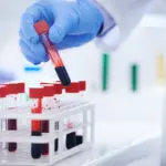 new-rapid-test-for-latent-tuberculosis-shows-promising-results