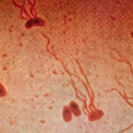 typhoid-fever-s-drug-resistance-spikes-urgent-action-required