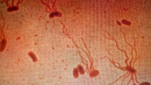 typhoid-fever-s-drug-resistance-spikes-urgent-action-required