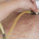 Another measles case has been linked to the Pilbara.