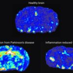 new-anti-inflammatory-drug-offers-hope-for-parkinson-s-treatment