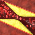 over-50-of-heart-attacks-in-younger-women-linked-to-non-blocked-arteries