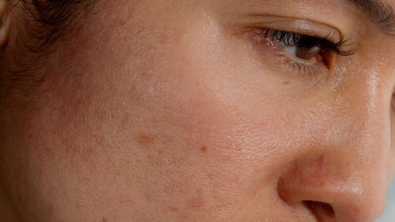 A closeup of a woman's face with red and inflamed skin in New York on Dec. 14, 2025.  (Eric Helgas/The New York Times)