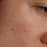 A closeup of a woman's face with red and inflamed skin in New York on Dec. 14, 2025.  (Eric Helgas/The New York Times)