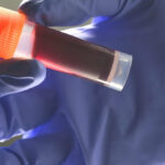 study-links-blood-type-a-to-increased-early-stroke-risk