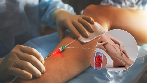 discover-effective-varicose-veins-treatments-and-recovery-times